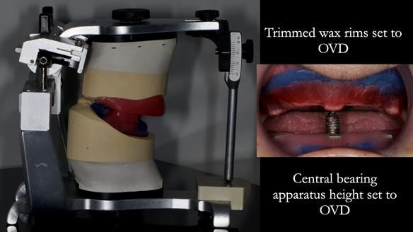 Newsletter 83: Sheila’s Complete Denture Success