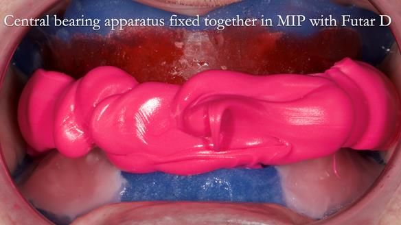 Newsletter 80 - Gordon’s dentures: the one case in 1,000 where my technique failed