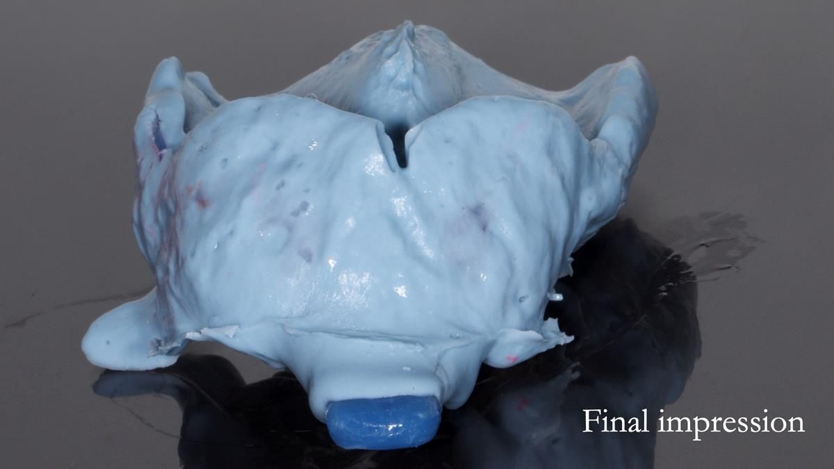 Newsletter 89 – Simon: A Challenging Kennedy Class II Division 1 Upper CoCr Partial Denture with a High Smile Line