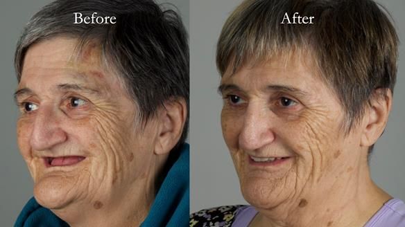 Newsletter 83: Sheila’s Complete Denture Success