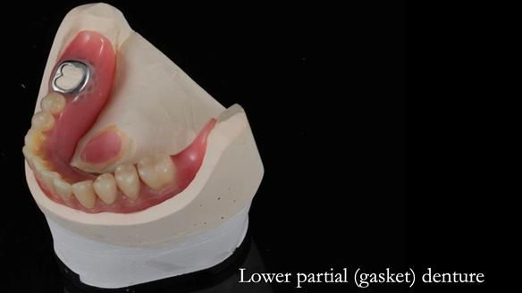 Newsletter 82 Mary - A complete upper and a one-tooth gasket denture