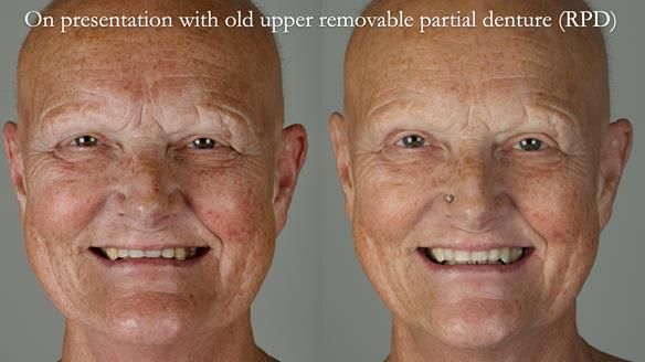 Newsletter 81 - Pam’s Story — how a partial denture changed her life (+ live walkthrough this Thursday)