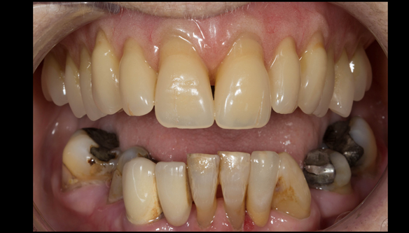 Figure 101 Mk 2 fitted definitive denture - Schottlander Enigmalife teeth