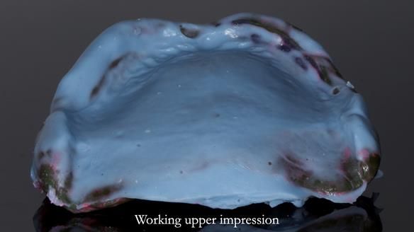 Newsletter 83: Sheila’s Complete Denture Success