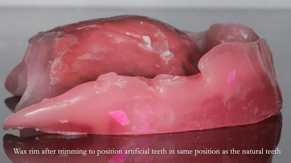 Finlay's Newsletter 62 provision of extractions and metal based complete dentures for Rafique