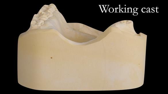 Upper metal base partial denture/occlusal stabilisation splint/obturator - full protocol