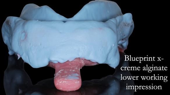 Newsletter 52 Managing Jo’s failing dentition with extractions and Mk 1/Mk 2 complete upper dentures and lower partial dentures FULL PROTOCOL