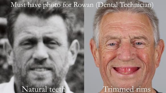 Newsletter 54 case presentation upper complete denture and lower Scandinavian designed hygienic partial denture for David