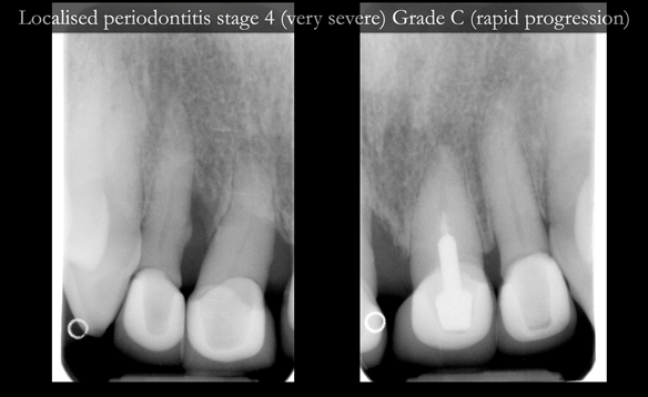 Figure 11 Localised periodontitis stage 4 (very severe) Grade C (rapid progression) - affecting the upper incisors