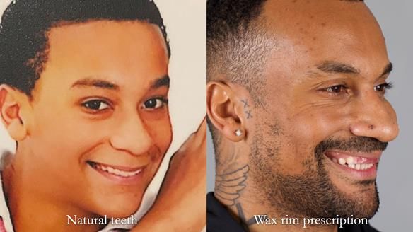 Upper metal base partial denture/occlusal stabilisation splint/obturator - full protocol