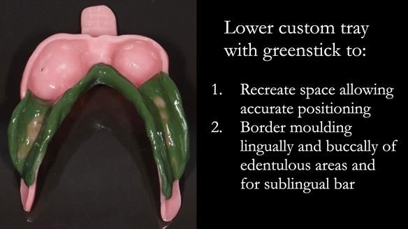 Finlay's Case Study Newsletter 40 - Immediate Mk 1 RPD to Definitive Mk 2 RPD - full protocol