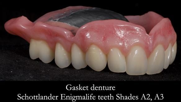 Finlay's Newsletter 58 Gasket upper partial denture for Zoe