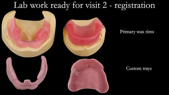 Complete denture Class II div 2 deep overbite Newsletter 39