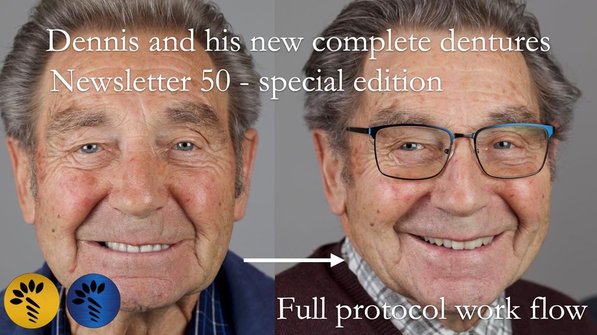 Full protocol - provision of metal reinforced complete dentures - including a step by step guide to custom tray production