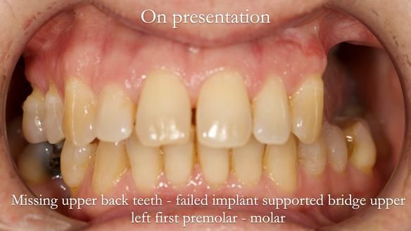 Solving Sue's failed implants with metal based RPD - full protocol Newsletter 43
