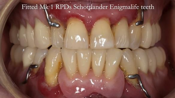 Finlay's Case Study Newsletter 40 - Immediate Mk 1 RPD to Definitive Mk 2 RPD - full protocol
