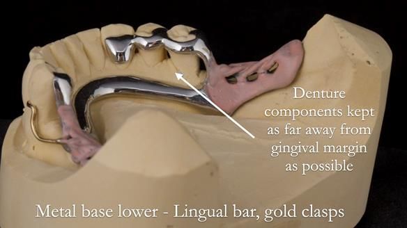 Solving Linda’s Failed “All on 4” implant bridges - full protocol Newsletter 42