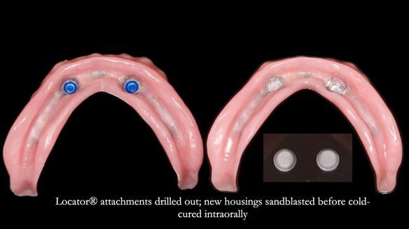 Newsletter 78: What do Clark Gable and a Locator® overdenture have in common?