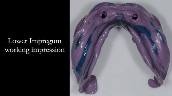 Newsletter 65 Marisa Provision of Complete Dentures on badly placed implants