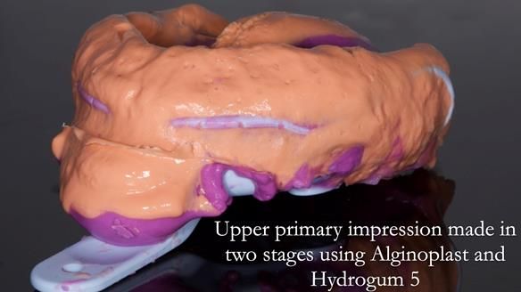 Finlay's Newsletter 64 case study - provision of a Kennedy class 2 metal based Scandinavian RPD for Ian