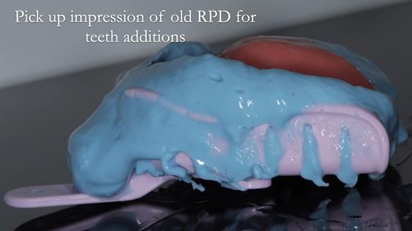 Finlay's Newsletter 62 provision of extractions and metal based complete dentures for Rafique