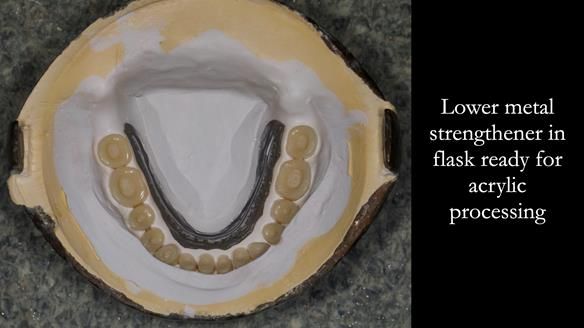 Newsletter 53 showing the making and fitting of ultra life-like dentures for Valena