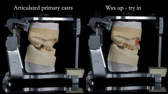 Newsletter 81 - Pam’s Story — how a partial denture changed her life (+ live walkthrough this Thursday)