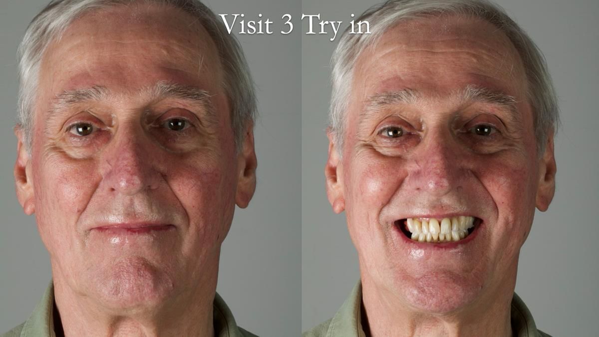 Newsletter 89 – Simon: A Challenging Kennedy Class II Division 1 Upper CoCr Partial Denture with a High Smile Line