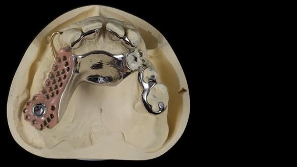 Newsletter 86 Peter the Architect — precision removable partial dentures case study