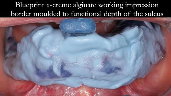 Finlay's Newsletter 61 provision of a lower unilateral free end saddle metal based partial denture for Joyce