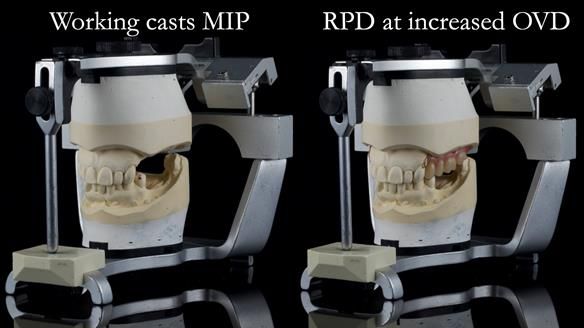 Finlay's Newsletter 60 Sylvia's upper Kennedy Class 2 Mod 1 metal based upper RPD