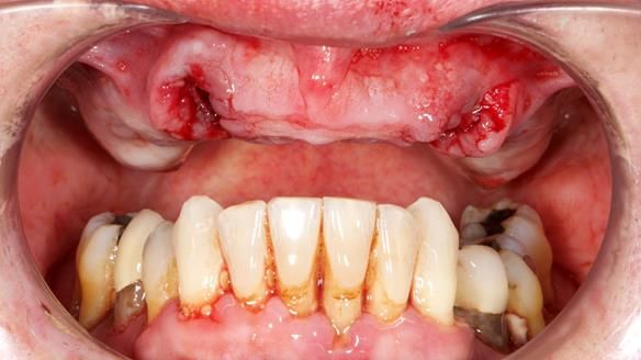Newsletter 77: Jeremy’s case – immediate complete upper denture