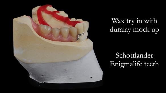 Finlay's Newsletter 61 provision of a lower unilateral free end saddle metal based partial denture for Joyce