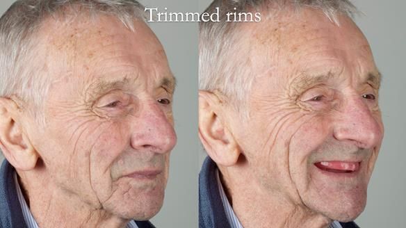 Newsletter 80 - Gordon’s dentures: the one case in 1,000 where my technique failed