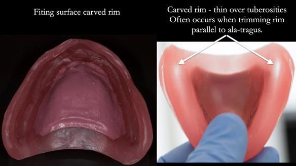 Newsletter 75: Marion’s case - Step-by-step complete denture workflow