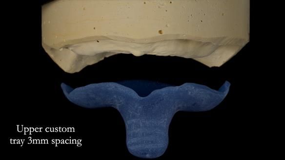 Newsletter 83: Sheila’s Complete Denture Success