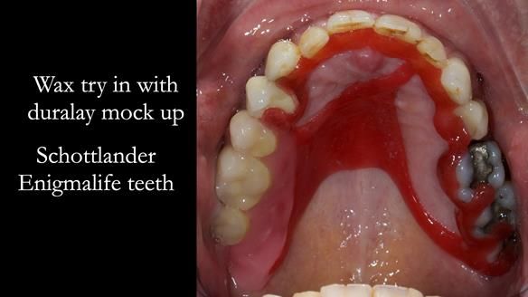 Finlay's Newsletter 64 case study - provision of a Kennedy class 2 metal based Scandinavian RPD for Ian