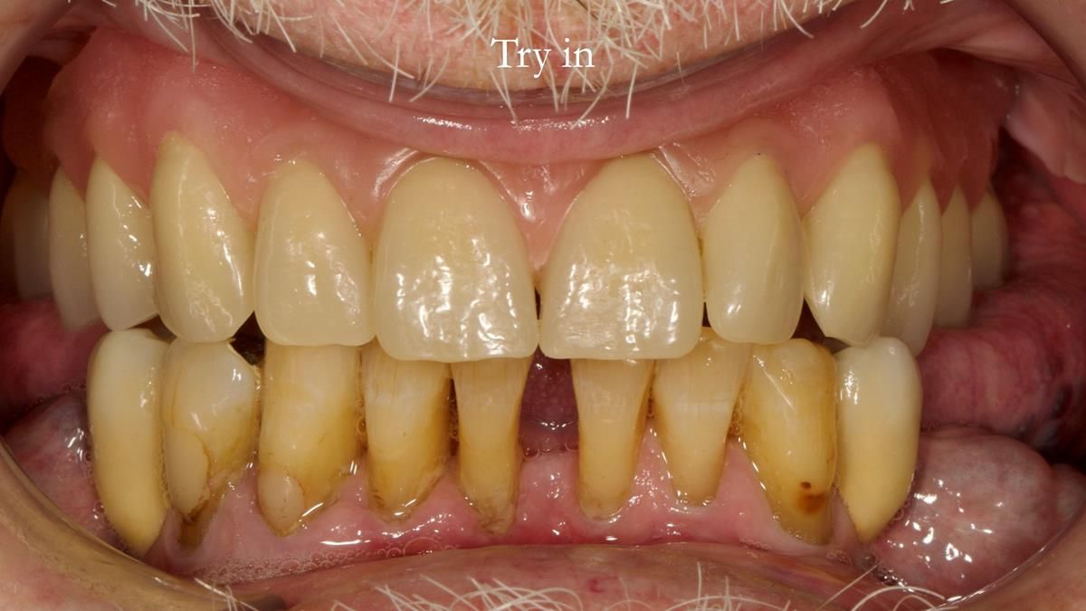 Newsletter 87 – Father Peter: A Partial Denture that needed Minor Miracle