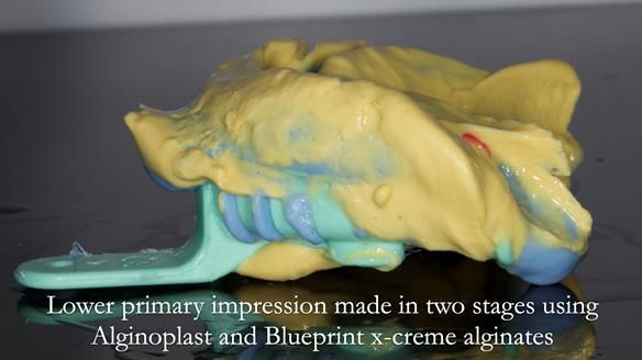 Newsletter 55 Provision of metal based partial dentures for Zephyrine with a repaired cleft lip and palate