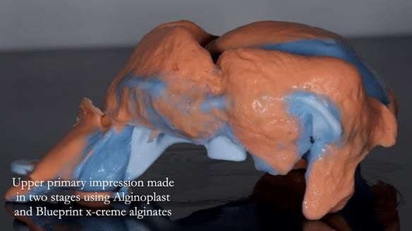 Newsletter 77: Jeremy’s case – immediate complete upper denture