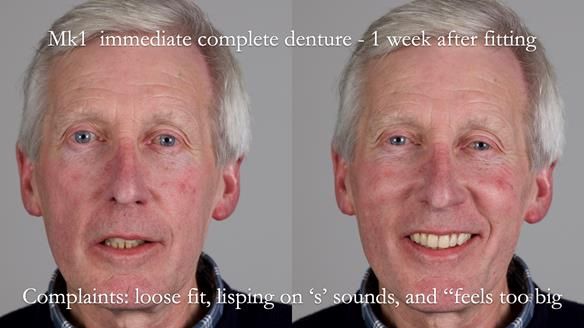 Newsletter 77: Jeremy’s case – immediate complete upper denture
