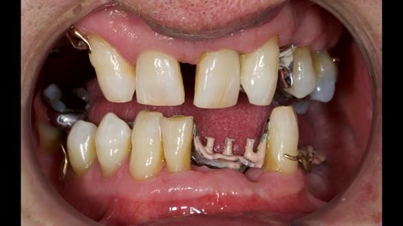 Newsletter 86 Peter the Architect — precision removable partial dentures case study