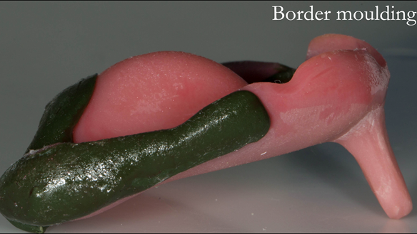 Figure 59 Custom tray border moulded with greenstick compound, ensuring a peripheral seal is obtained
