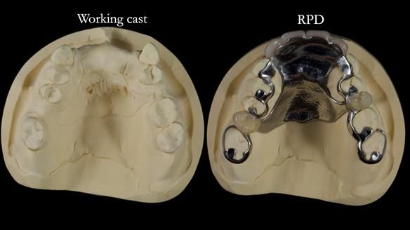 Newsletter 81 - Pam’s Story — how a partial denture changed her life (+ live walkthrough this Thursday)