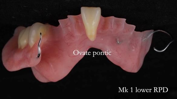 Newsletter 54 case presentation upper complete denture and lower Scandinavian designed hygienic partial denture for David