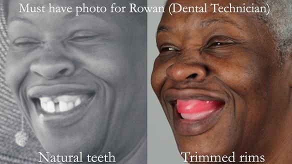 Newsletter 53 showing the making and fitting of ultra life-like dentures for Valena