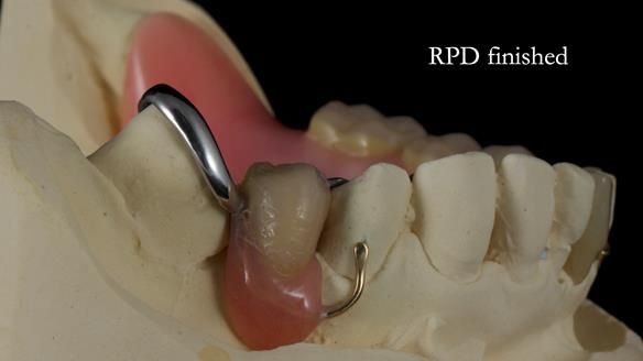Newsletter 55 Provision of metal based partial dentures for Zephyrine with a repaired cleft lip and palate