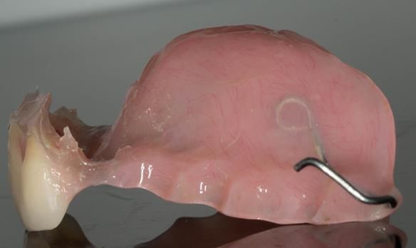  Figure 39 - Wax peeled off and Visco-gel can be trimmed and tidied with blade