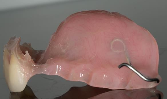 Figure 39 - Wax peeled off and Visco-gel can be trimmed and tidied with blade