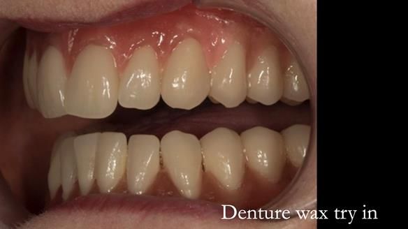 Newsletter 75: Marion’s case - Step-by-step complete denture workflow